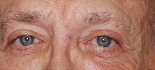 Eyelid Lift (Blepharoplasty) After Patient 1