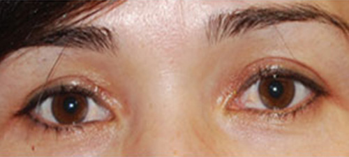 Eyelid Lift (Blepharoplasty) After Patient 2