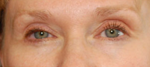 Eyelid Lift (Blepharoplasty) After Patient 3