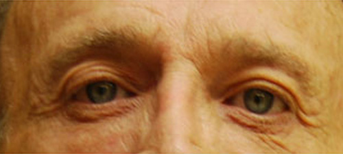 Eyelid Lift (Blepharoplasty) Before Patient 1