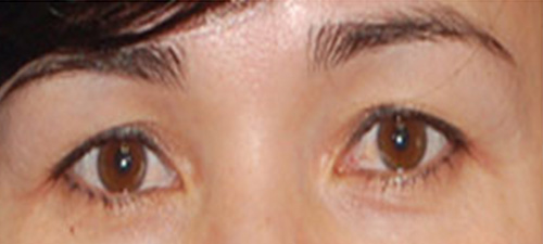 Eyelid Lift (Blepharoplasty) Before Patient 2