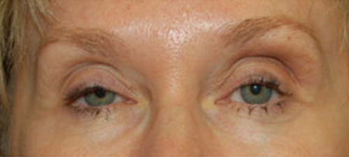 Eyelid Lift (Blepharoplasty) Before Patient 3
