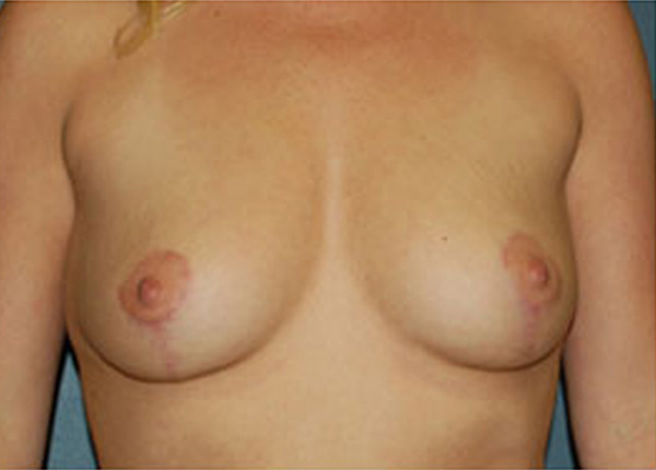 Breast Lift After Patient 1