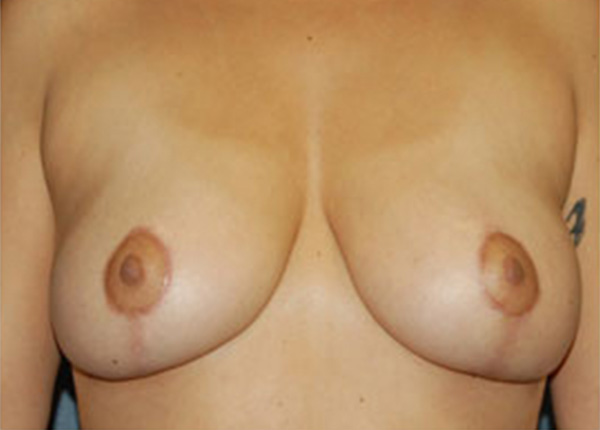 Breast Lift After Patient 2