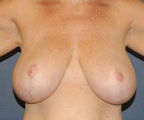 Breast Reduction After Patient 1