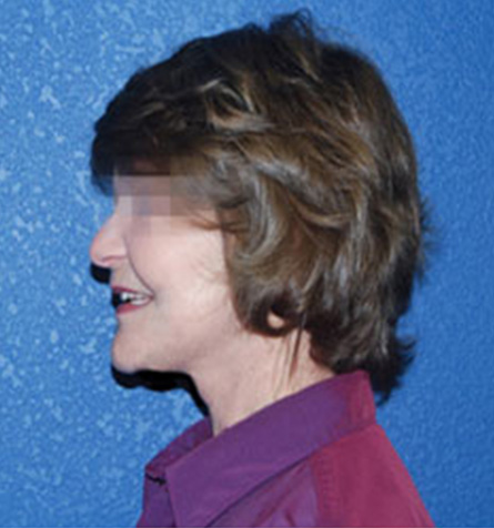 Facelift Surgery After Patient 2