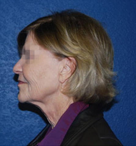 Facelift Surgery Before Patient 2