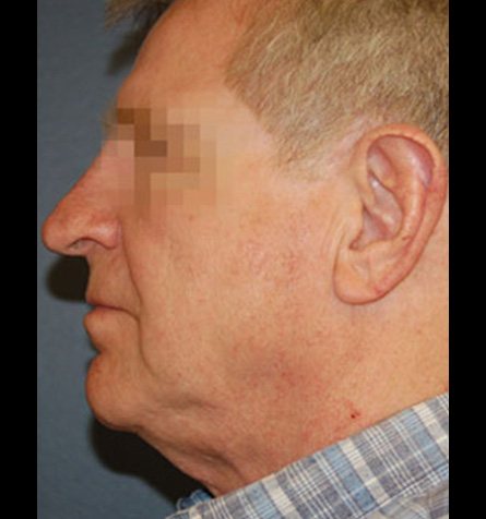 Facelift Surgery Before Patient 3