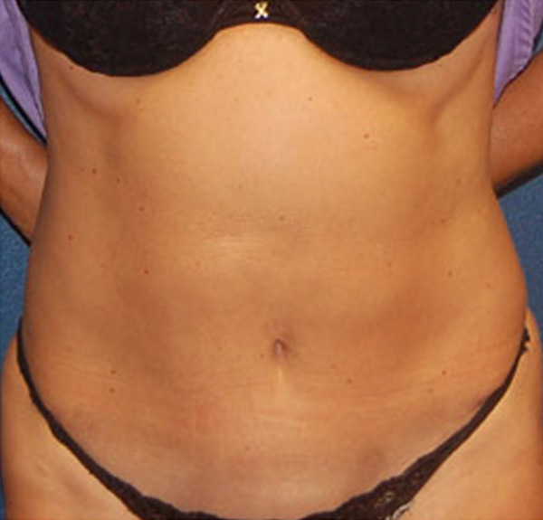 Liposuction After Patient 1
