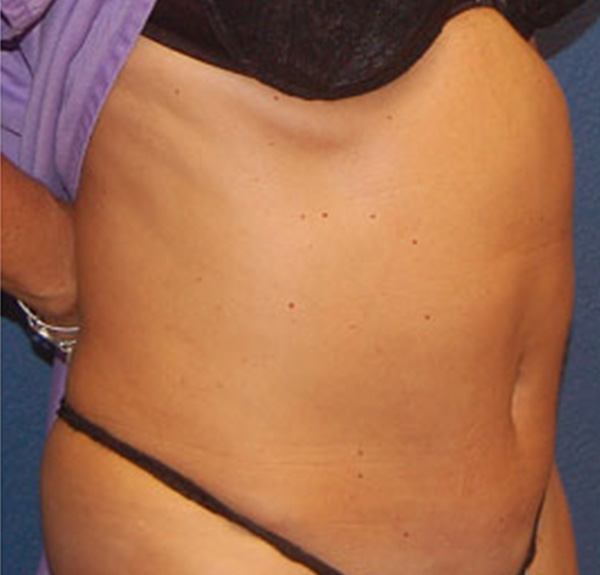 Liposuction After Patient 2