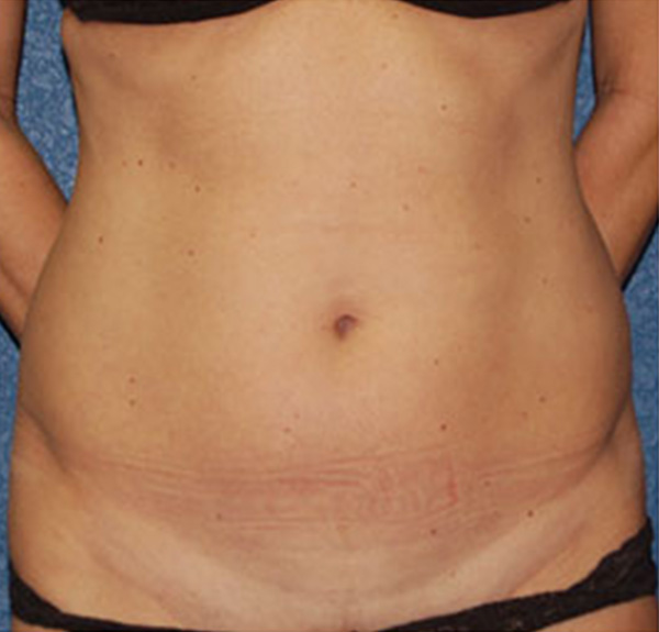 Liposuction Before Patient 1