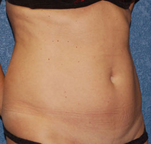 Liposuction Before Patient 2