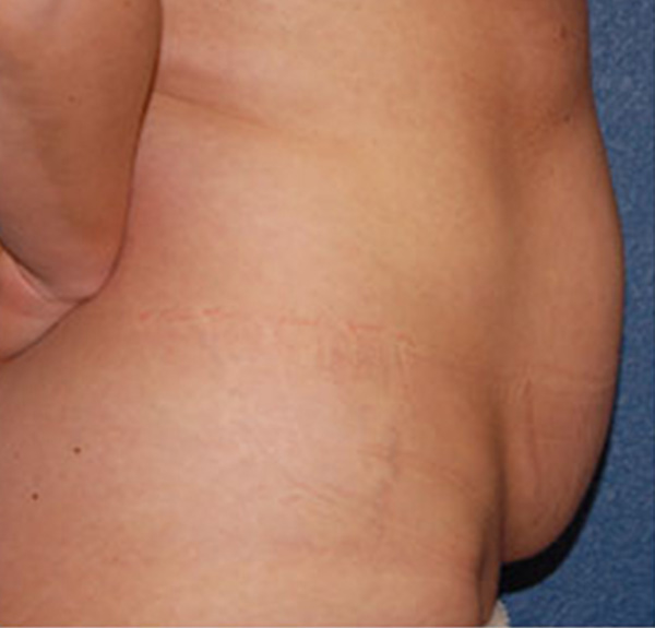 Liposuction Before Patient 3