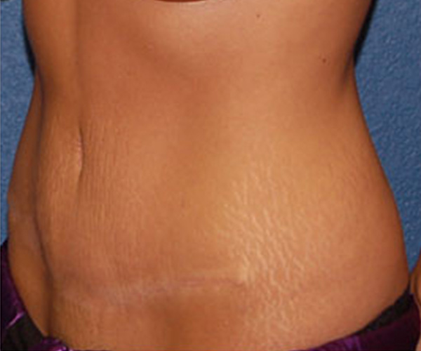 Tummy Tuck After Patient 1