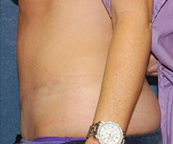 Tummy Tuck After Patient 2