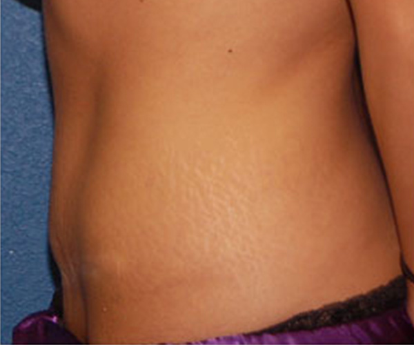 Tummy Tuck After Patient 3