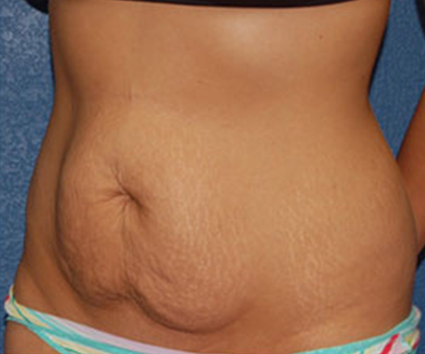 Tummy Tuck Before Patient 1