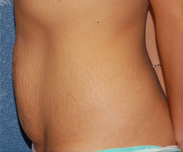 Tummy Tuck Before Patient 3