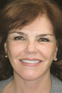 Case--9638 | After Quick Lift