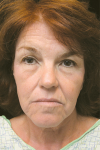 Case--9638 | Before Quick Lift