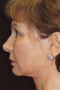 Case--8713 | After Quick Lift