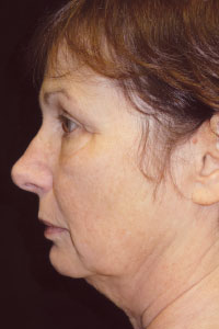 Case--8713 | Before Quick Lift