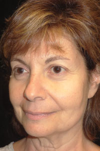 Case--1644 | Before Quick Lift