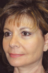 Case--1644 | After Quick Lift