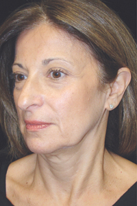 Case--7924 | Before Quick Lift