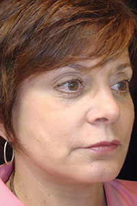 Case--2546 | After Quick Lift