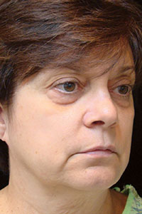 Case--2546 | Before Quick Lift