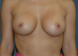 Case--9944 | After Breast Augmentation