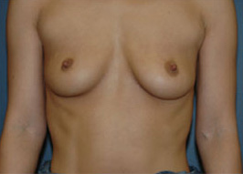 Case--9944 | Before Breast Augmentation