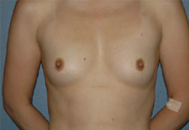 Case--5928 | Before Breast Augmentation