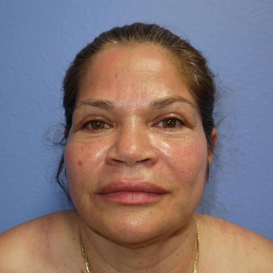 Case--6300 | After Eyelid Lift