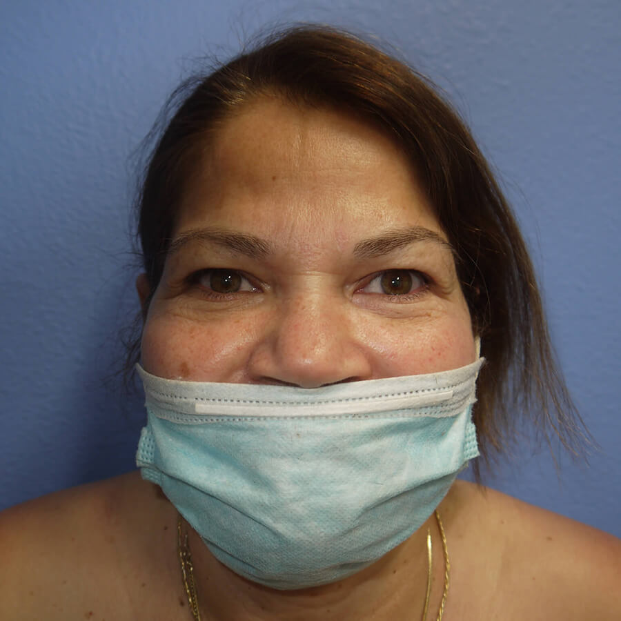 Case--6300 | Before Eyelid Lift