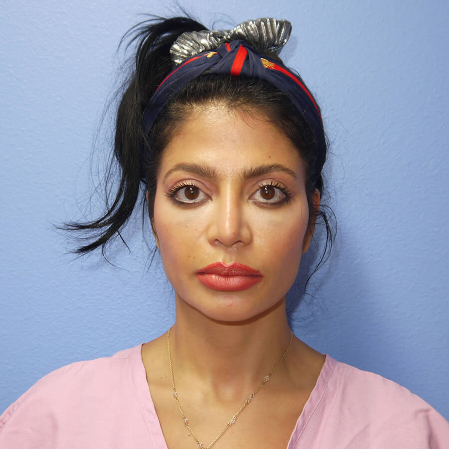 Case--9198 | After Eyelid Lift