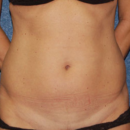Case--5621 | Before Liposuction