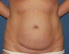 Case--8233 | Before Liposuction
