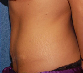 Case--6392 | After Tummy Tuck