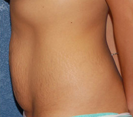 Case--6392 | Before Tummy Tuck