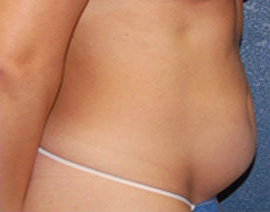 Case--4089 | Before Tummy Tuck