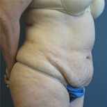 Case--1199 | Before Tummy Tuck