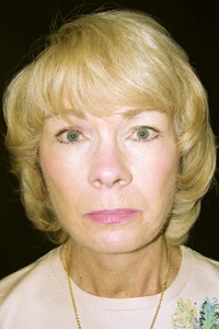 Case--2504 | After Quick Lift