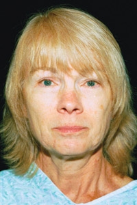 Case--2504 | Before Quick Lift