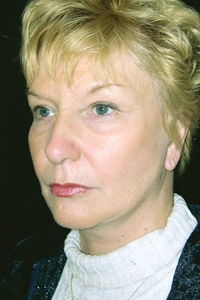 Case--8353 | After Quick Lift