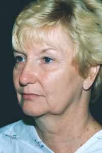 Case--8353 | Before Quick Lift