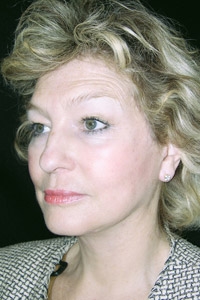 Case--6730 | After Quick Lift