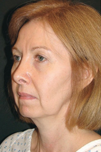 Case--9050 | Before Quick Lift