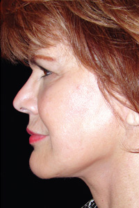 Case--4589 | After Quick Lift